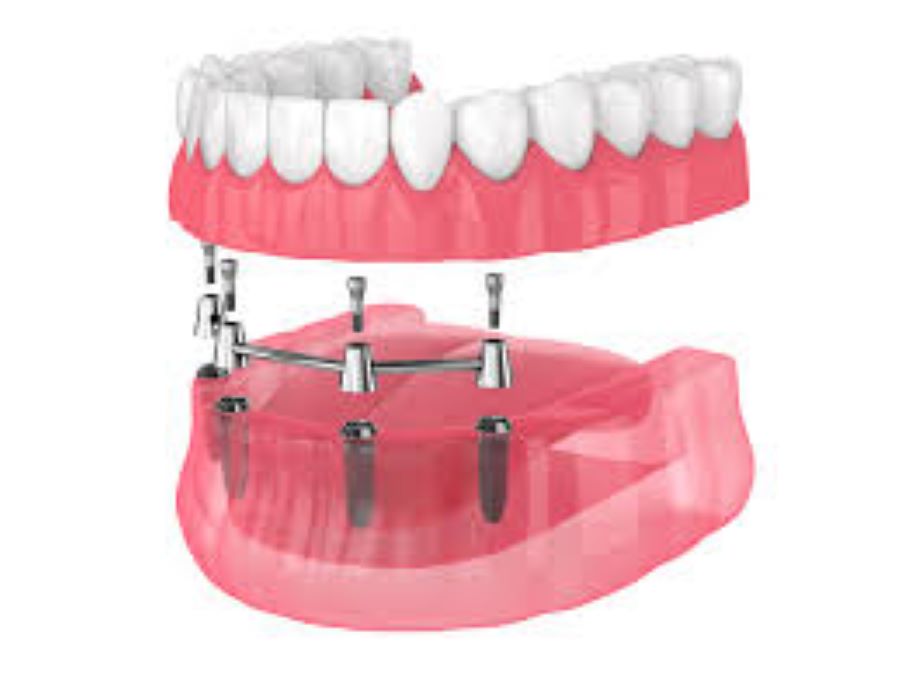 All-on-4 dental implants in Duxbury, near Cape Cod and South Boston, MA